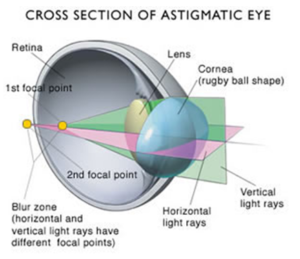 Αστιγματισμός - Δρ Κ. Καραμπάτσας - Χειρουργός Οφθαλμίατρος