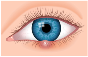 Κριθαράκι στο μάτι - Δρ Κ. Καραμπάτσας - Χειρουργός Οφθαλμίατρος