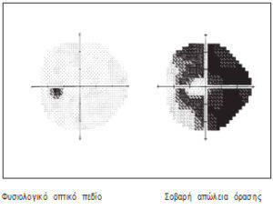 Εξέταση οπτικών πεδίων. Τι είναι; Πως γίνεται; - Δρ Κ. Καραμπάτσας - Χειρουργός Οφθαλμίατρος