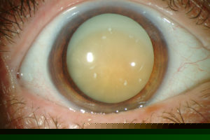 Καταρράκτης & διατροφικές συνήθειες - Δρ Κ. Καραμπάτσας - Χειρουργός Οφθαλμίατρος