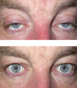 Βλεφαρόπτωση - Δρ Κ. Καραμπάτσας - Χειρουργός Οφθαλμίατρος