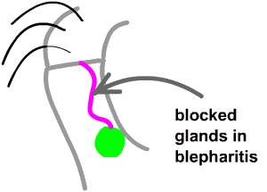Βλεφαρίτιδα