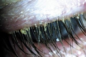 Βλεφαρίτιδα