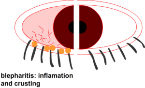 Βλεφαρίτιδα