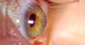 Κερατόκωνος: Μια πάθηση που αντιμετωπίζεται πολύ αποτελεσματικά με τις καινούργιες θεραπείες