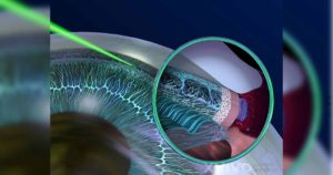 SLT - η ήπια εναλλακτική laser λύση για τη θεραπεία γλαυκώματος