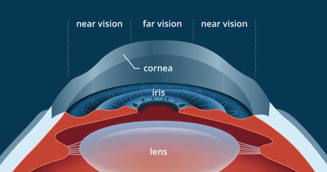 ΑΝΤΙΜΕΤΩΠΙΣΗ ΤΗΣ ΠΡΕΣΒΥΩΠΙΑΣ με LASER